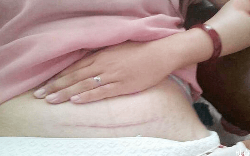 详细剖腹产消毒视频教程：正确流程和技巧解析