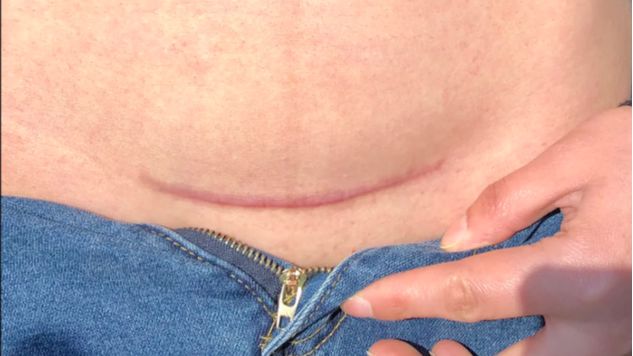剖腹产手术消毒视频_剖宫产消毒顺序及操作视频_剖腹产消毒视频教程